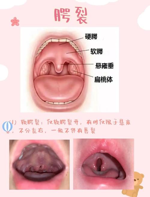 唇顎裂有補助嗎