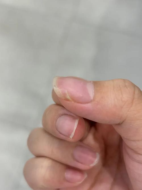 指甲斷一半
