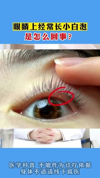眼皮長水泡怎麼辦