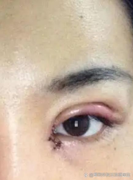割雙眼皮撐多久