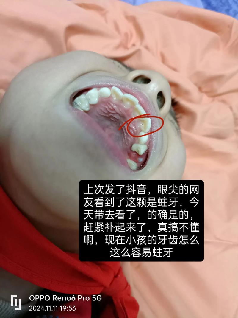 蛀牙會蛀到骨頭嗎