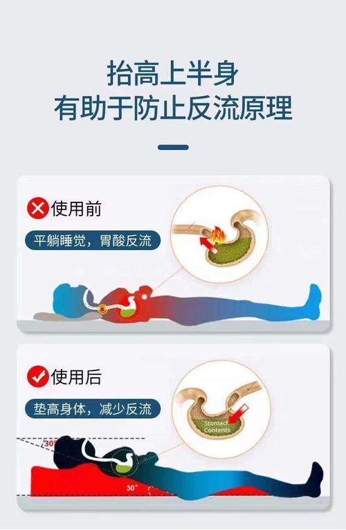 胃酸倒流做什麼運動