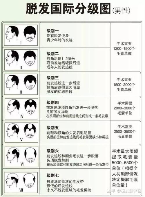 植髮一株多少錢
