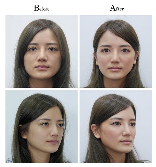 洢蓮絲 淚溝:告別眼下凹陷,找回自信明亮雙眸的秘密! 3 洢蓮絲 淚溝