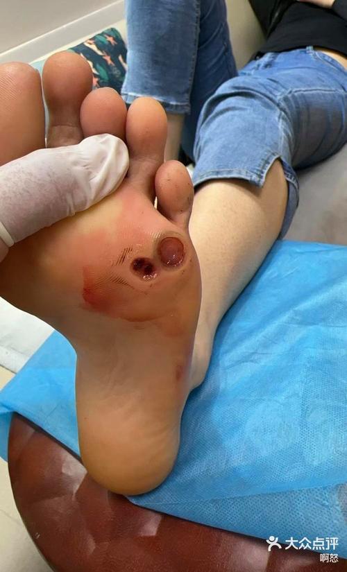 雞眼會理賠嗎