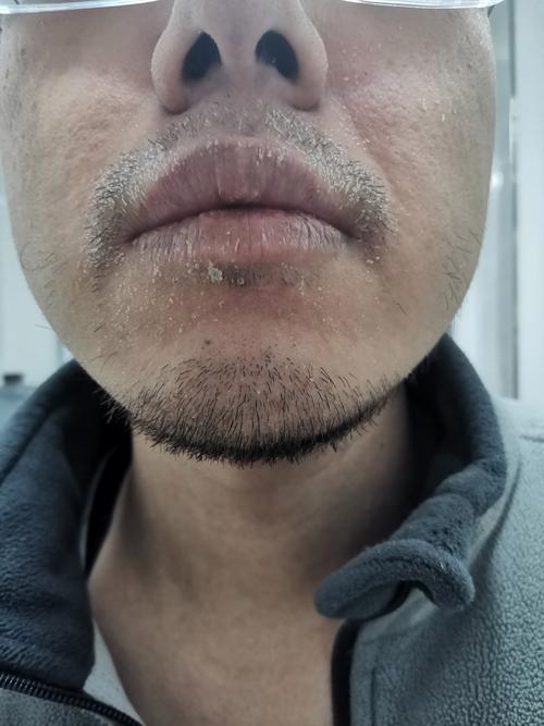 合成皮脫皮