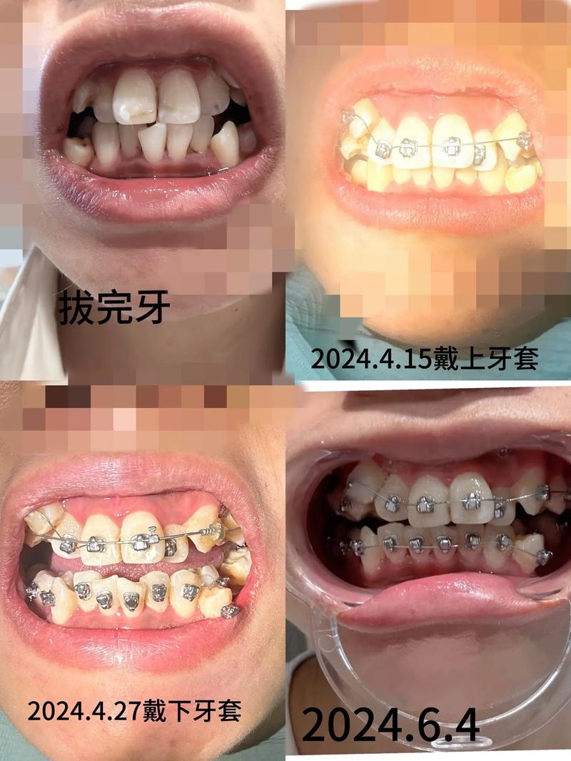 牙套會蛀牙嗎