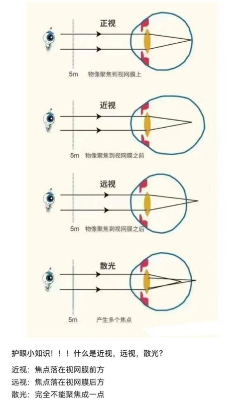 散光跟近視差在哪
