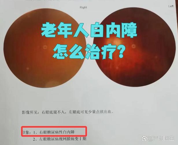 中風可以開白內障嗎