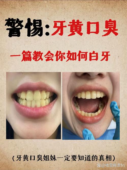 戒菸牙齒會變白嗎