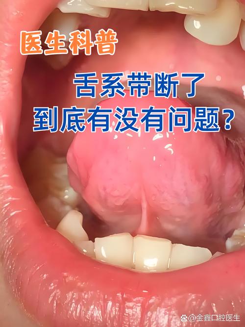 為什麼剪舌繫帶