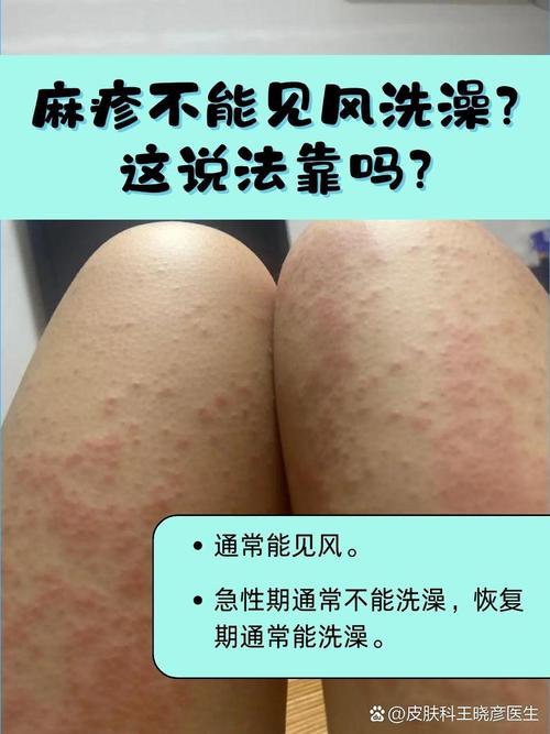 為什麼會起疹子