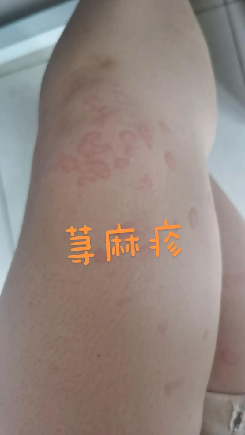 麻疹一生會得幾次