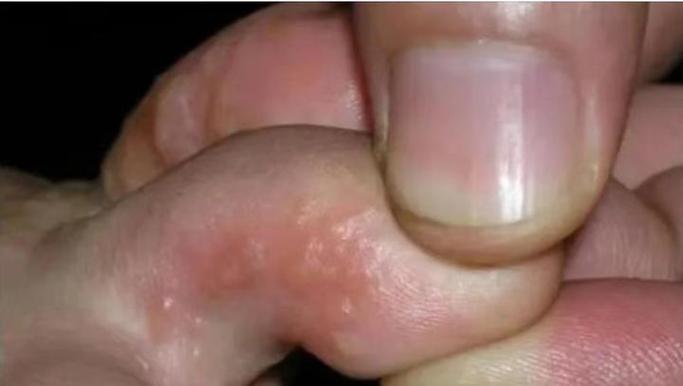 為什麼腳一直長水泡