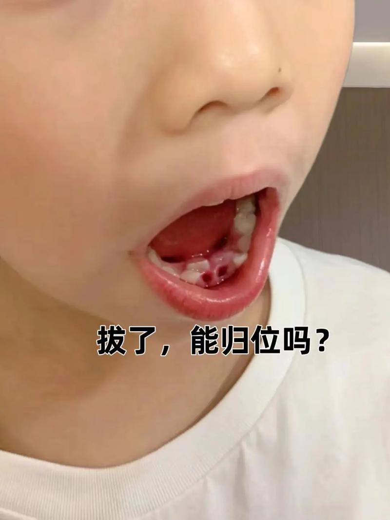 乳牙沒掉恆牙長出來怎麼辦
