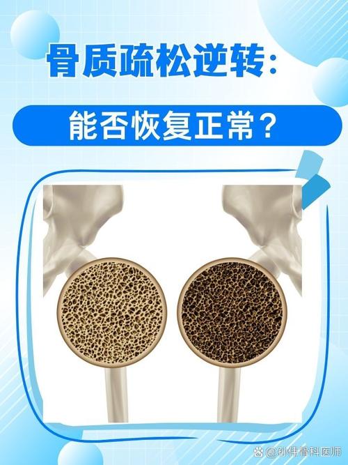 骨質密度可以逆轉嗎
