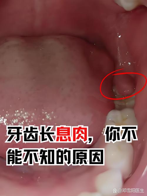 口腔息肉會消嗎