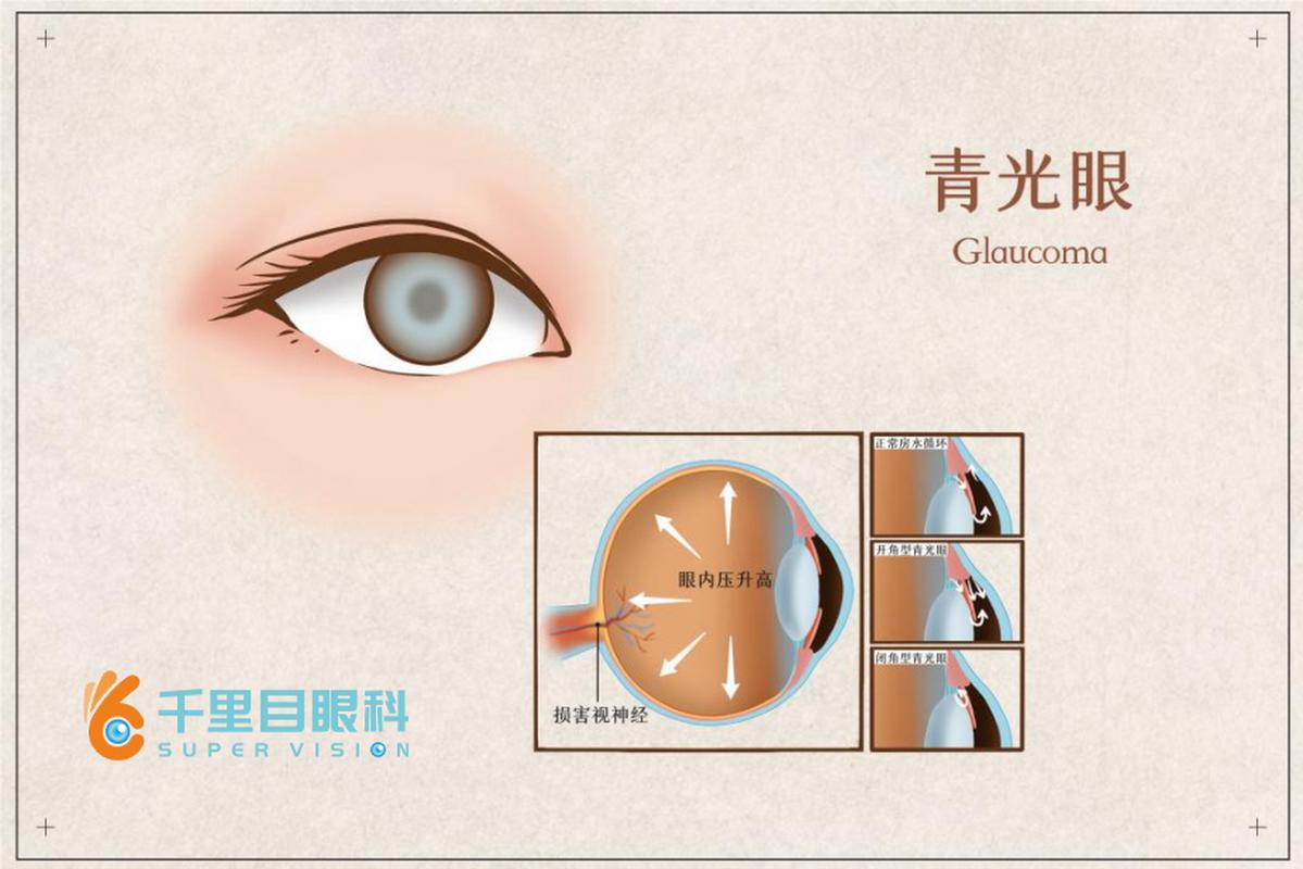 小孩會得青光眼嗎