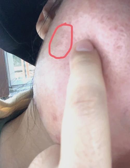 雷射一個月打一次