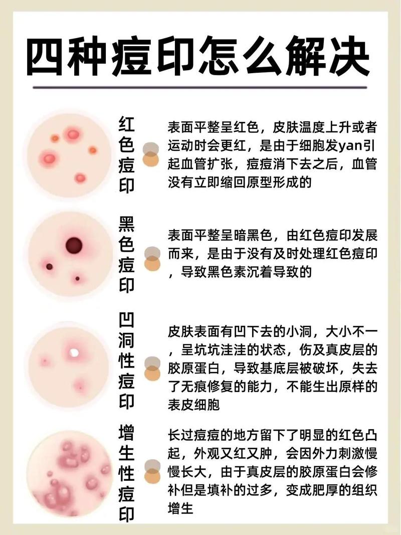 痘印怎麼消