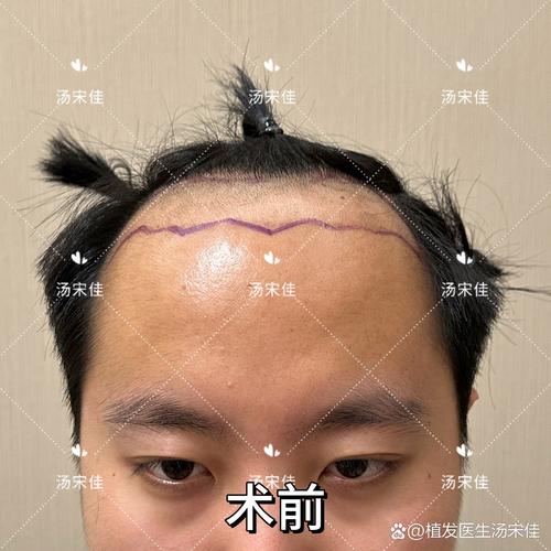 幾歲植髮比較適合