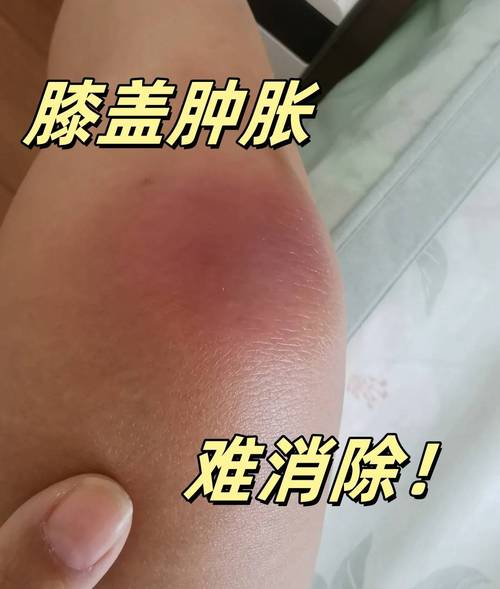 如何消除膝蓋腫脹