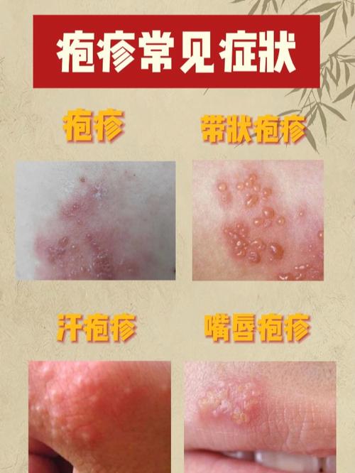 為什麼會一直長皰疹