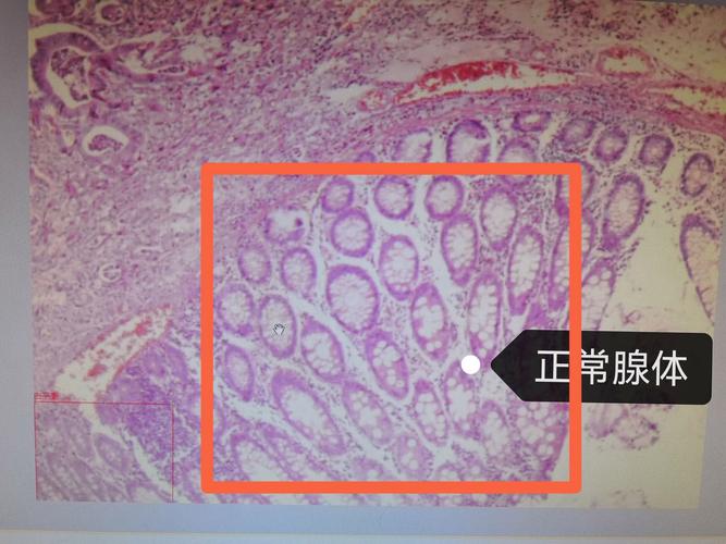 胃潰瘍切片理賠