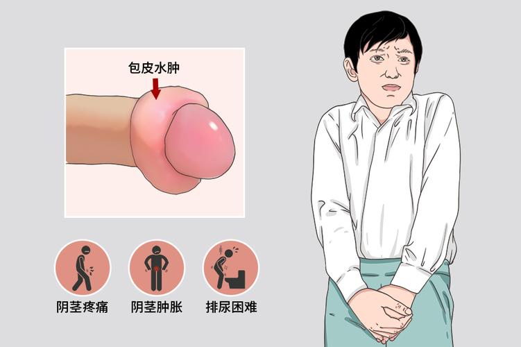 包皮要一直翻開嗎