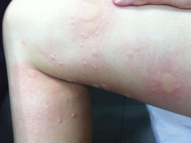 皮膚一包很癢:深度解析惱人搔癢的成因、舒緩與預防之道 3 皮膚一包很癢