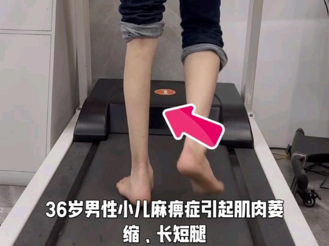 小兒麻痺遺傳