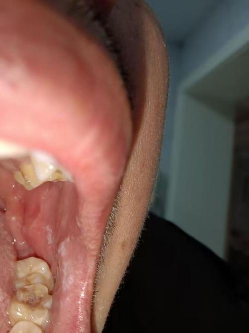 口腔扁平苔蘚 會自己好嗎