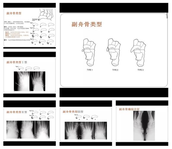 為什麼會有附生舟狀骨