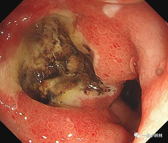 十二指腸潰瘍症狀