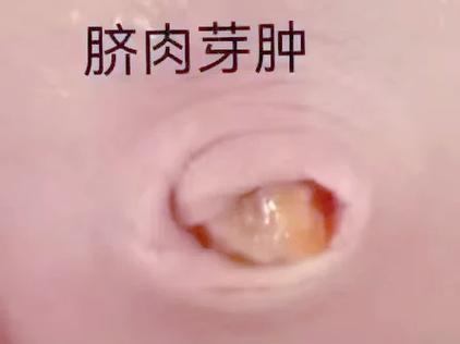 肚臍息肉