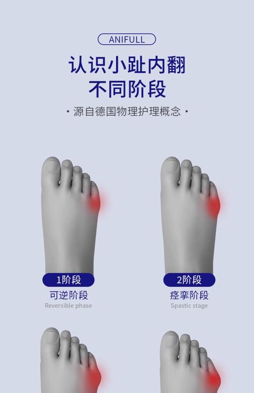 分趾套睡覺能穿嗎?深度解析夜間使用分趾套的利弊、注意事項與專業建議 1 分趾套睡覺能穿嗎