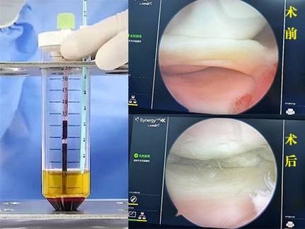 半月板破裂打PRP有效嗎