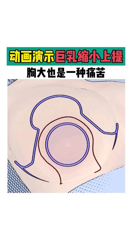 胸部太大如何變小