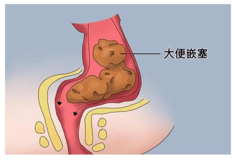 屎太硬怎麼辦?專家教你告別硬便困擾,重拾暢快人生! 1 屎太硬怎麼辦