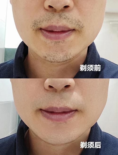 如何永久去除鬍子