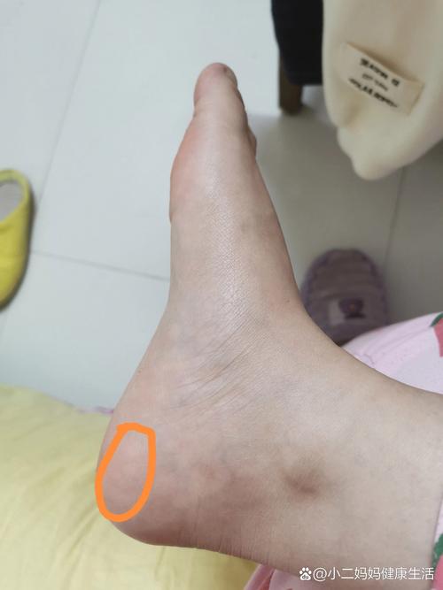 後腳跟癢:從常見困擾到潛在健康警訊的深度解析與舒緩之道 3 後腳跟癢