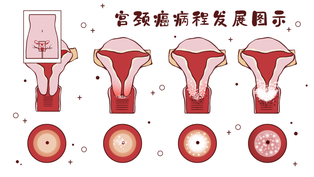 子宮頸癌會死嗎