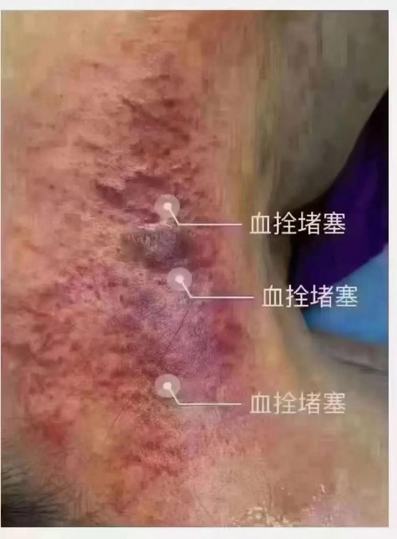 刮痧很紅是為什麼