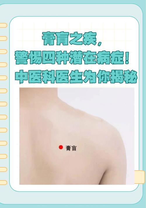 膏肓怎麼按?深層舒緩膏肓痛的穴位按摩技巧與日常保健全攻略 3 膏肓怎麼按