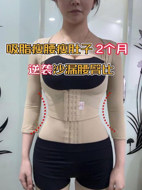 抽脂後多久LPG?從術後黃金恢復期到完美曲線的專業指南 3 抽脂後多久LPG