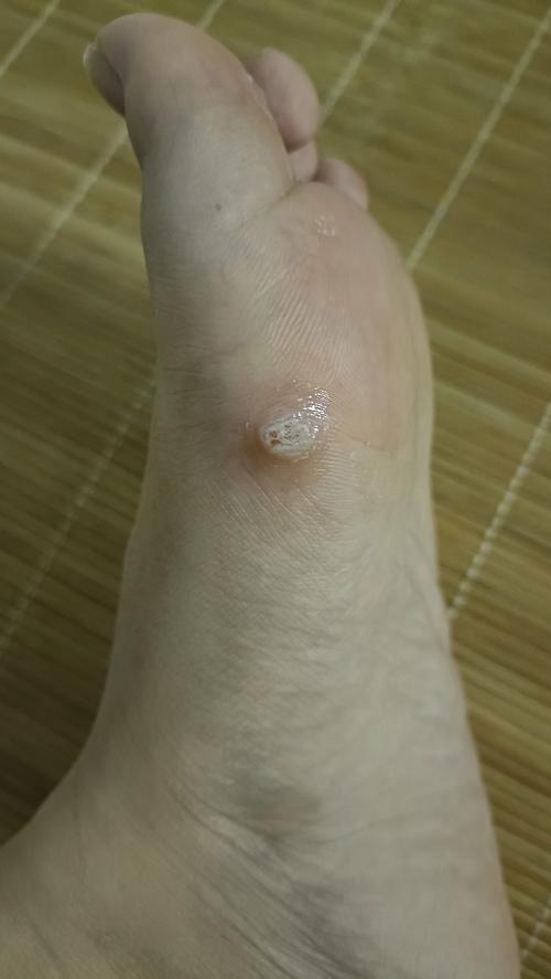 繭跟雞眼一樣嗎