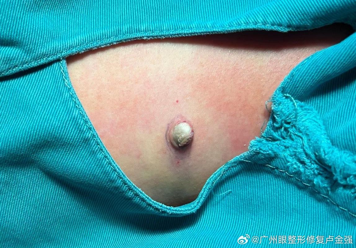 粉瘤擠壓會怎樣