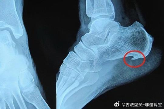腳底為什麼會長骨刺?從成因、症狀到治療與預防的深度解析 3 腳底為什麼會長骨刺