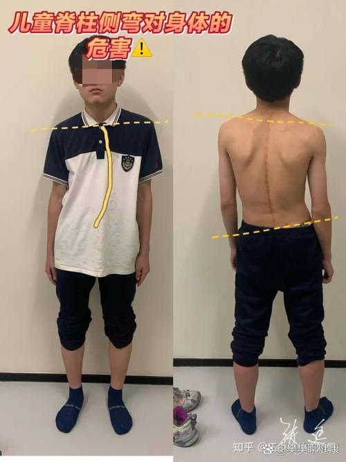 脊椎側彎會影響身高嗎