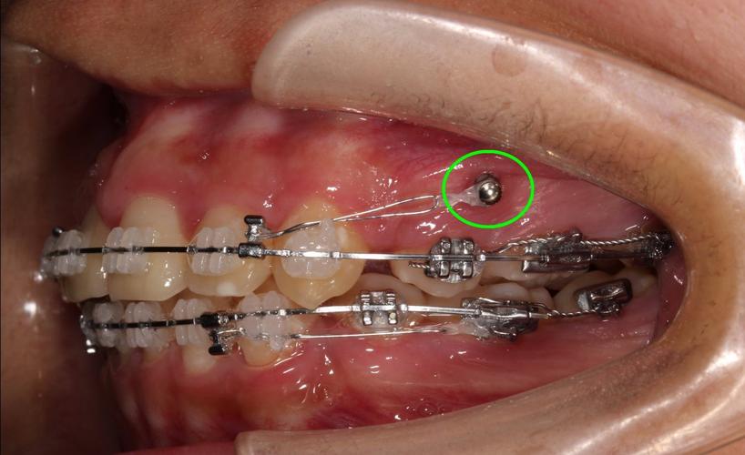 牙釘會痛嗎?深度解析牙髓治療後的重建與舒適度 1 牙釘會痛嗎